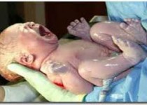 سزارین پرمخاطره ترین نوع زایمان/مشکلات تنفسی در کمین نوزادان سزارینی