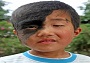پسری که نصف صورتش مثل میمون است+عکس
