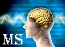 300 بیمار مبتلا به ام‌اس در سیستان و بلوچستان شناسایی شد