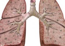 لاغرها ریه‌های سالم‌تری دارند