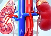 استرس و شغل‌های پشت میزی خطر سنگ کلیه را افزایش می‌دهد