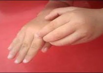 خارش و خشکی پوست نشانه‌های اصلی نارسایی کلیه