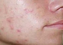 "مشکلات روانی" موجب افزایش جوش‌های پوستی می‌شود