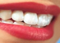 ابداع روشی نوین برای پیشگیری از پوسیدگی دندان