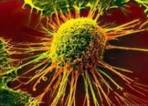 علائم اولیه سرطان را بشناسید