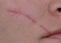 جای زخم بر روی پوست های سبزه بیشتر می ماند