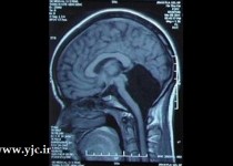 زنی که با نصف مغز زندگی می کند +عکس