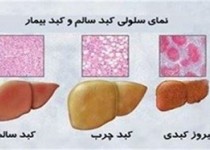 برای پیشگیری از کبد چرب حتما این نکات را رعایت کنید برای پیشگیری از کبد چرب حتما این نکات را رعایت کنید