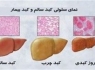 برای پیشگیری از کبد چرب حتما این نکات را رعایت کنید