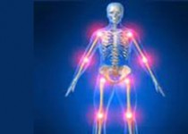 با این ورزش‌ها از بروز آرتروز پیشگیری کنید