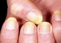 وسواس، یکی از علل پوسته شدن اطراف ناخن