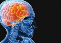 علامت اصلی سکته مغزی