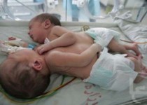 تولد دو قلوهای به هم چسبیده در شیراز+عکس