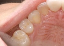 دندان درد را با این روش تسکین دهید