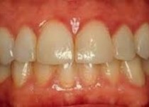 عفونت لثه را جدی بگیرید