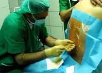 نخستین پیوند نخاع در دنیا