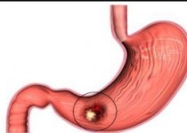 درمان آسان برای ترش کردن معده