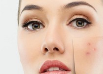 چگونه می توان جای جوش هایمان را از بین برد؟