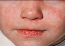 سرخک مهمان سیستان و بلوچستان/ هشدار جدی در مشاهده هر گونه"تب"