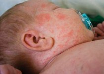 بیماری سرخک نگران کننده نیست