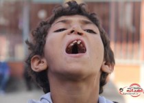 زندگی با نادرترین بیماری/ تنها آرزویم حرف زدن مانند هم سن و سالانم است