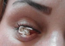 حادثه حیرت انگیز در قوه بینایی بانوی اصلاندوزی/چشمی که نخ تولید می کند+عکس و فیلم