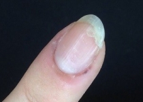 شکستن و خرد شدن ناخن‌ها؛ آژیر خطر برای مشکلات جدی‌تر