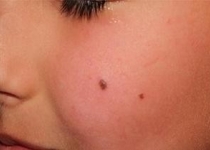 وجود این علائم در خال ها نشانه سرطان است