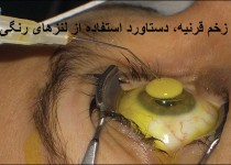 زخم قرینه دستاورد استفاده از لنزهای رنگی/ از تهدید سلامت شهروندان تا فروش غیربهداشتی لنز در زاهدان