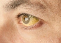 علائمی که حکایت از نارسایی‌های کبد دارند