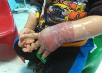 سوختگی دست چند کودک به واسطه استفاده از چسب تاریخ گذشته+ تصاویر