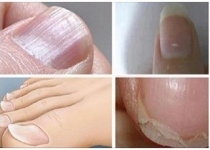 وقتی ناخن‌ها خبر از یک مشکل سلامت جدی می‌دهند