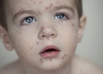 آبله‌مرغان سراغ چه كسانی می‌رود؟ / با این سوپ آبله‌مرغان را در خانه درمان کنید