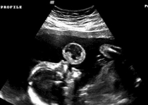 تصویر عجیب سونوگرافی که پزشکان را در بهت و حیرت فرو برد + عکس