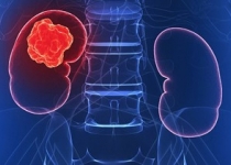 5 نشانه ای که به شما می گوید سرطان دارید یا نه