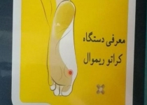 درمان بدون درد "پینه پا" با دستگاه ایرانی/ مراجعه‌کنندگان غیردیابتی بیشتر از دیابتی‌ها هستند