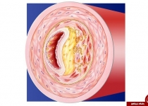 با دیدن این علائم در چشم ها باید به سکته مغزی و دیابت شک کرد!