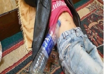 هزینه‌های پزشکی کَمَرَم را شکسته / پیوند مثانه تنها راه نجات کودک 11ساله کهگیلویه ای+تصاویر