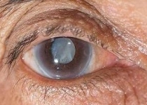 این بیماری خطرناک چشمی را بشناسید
