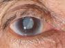 این بیماری خطرناک چشمی را بشناسید