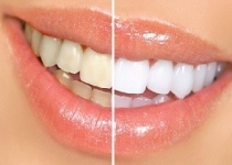 برطرف کردن جرم دندان با روش‌های طبیعی