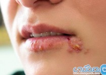 تبخال زدن بیش از دو بار در سال غیرعادی است