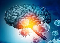 سکته‌های مغزی، عوارض بعد از ابتلا به کرونا