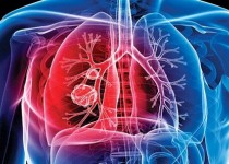 سل شایع ترین علت مرگ در بیماری های عفونی/ اُفت شناسایی موارد "سل" در کشور به دلیل کرونا