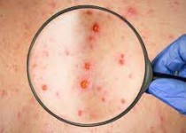 بهترین و اصلی ترین راه پیشگیری از ابتلا به سرخک واکسیناسیون است