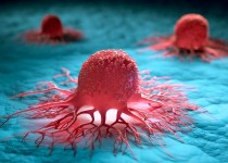 سرطان قابل پیشگیری است، با خودمراقبتی و امید/ سرطان دهانه رحم چهارمین سرطان شایع زنان