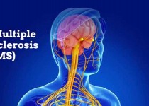 چه کسانی در معرض بیماری ام اس هستند/ زنان بیشترین گروه در معرض خطر