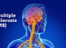 چه کسانی در معرض بیماری ام اس هستند/ زنان بیشترین گروه در معرض خطر