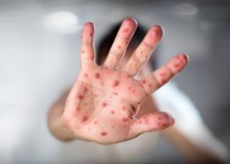 طرح غربالگری سل و واکسیناسیون تکمیلی اتباع غیر ایرانی در زاهدان اجرا شد