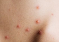 آبله مرغان بیماری مسری اوایل بهار